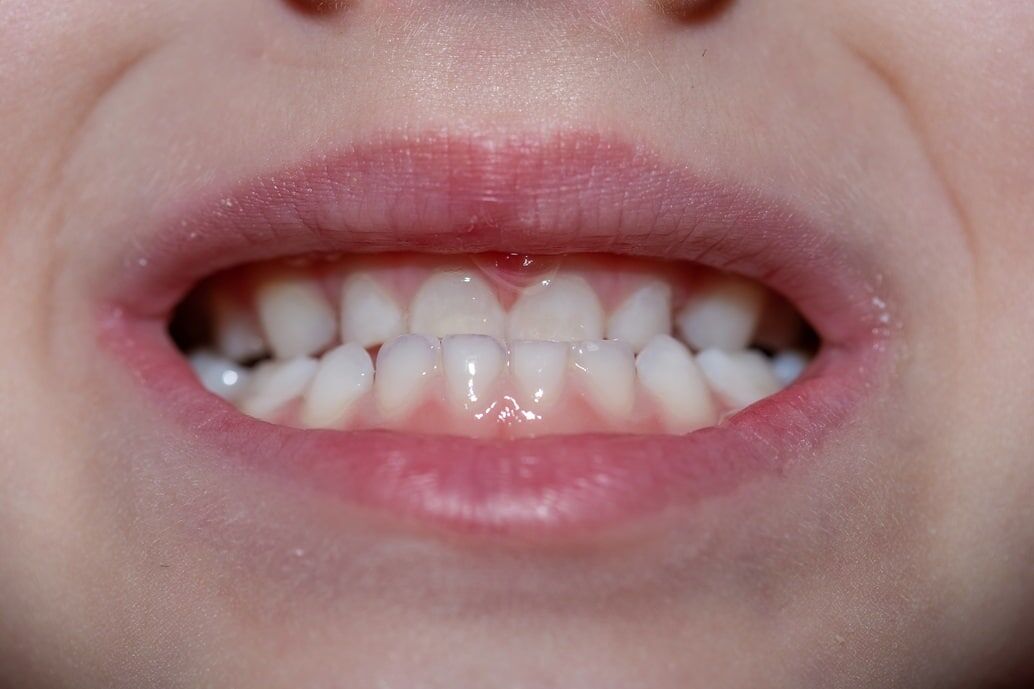Correcting an underbite